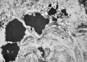 M,66y. | follicular cyst with hyaline Rushton bodies M,66y. | follicular cyst with hyaline Rushton bodies
